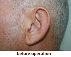 plastic-surgery-prominent-ear 